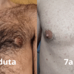 EPILAZIONE DEFINITIVA MASCHILE:…